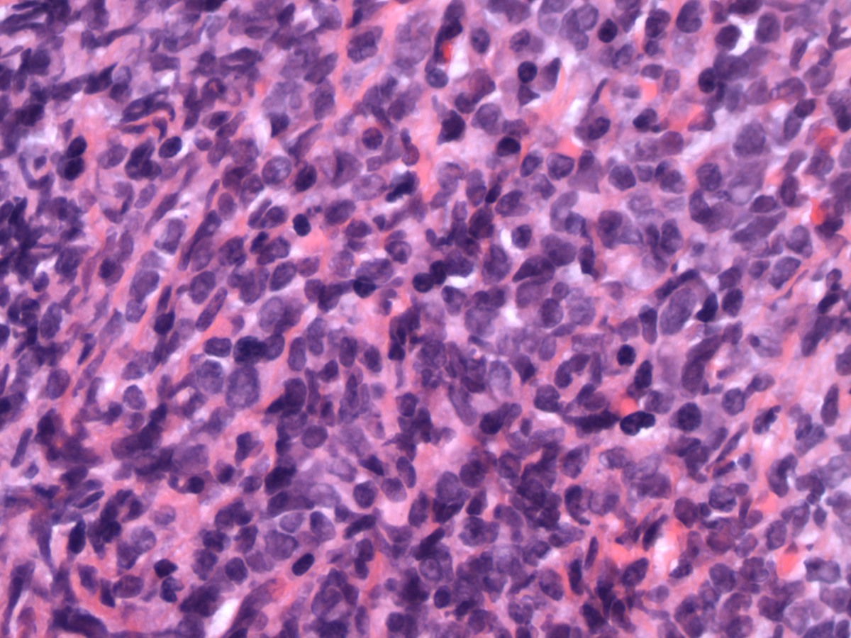 Histologic sections of the breast show an extensive infiltration of immature cells with fine chromatin, distinct nucleoli and moderate amount of cytoplasm (H&E, 400x).